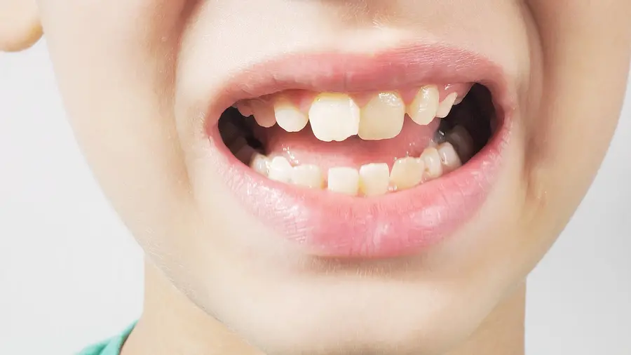 How to Get Your Children Ready for a Tooth Extraction